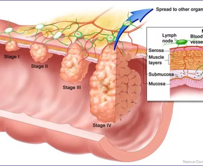 Breaking the Silence on Colon Cancer